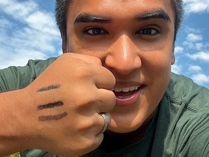 A man holding his marked hand beside his face