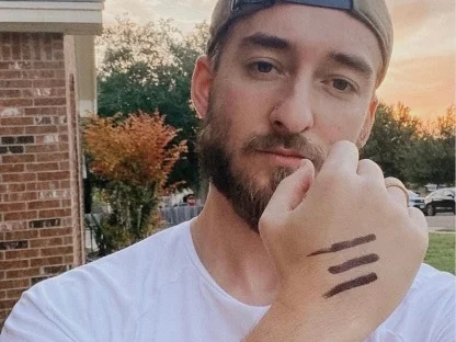 A man outdoors showing the marks on the back of his hand
